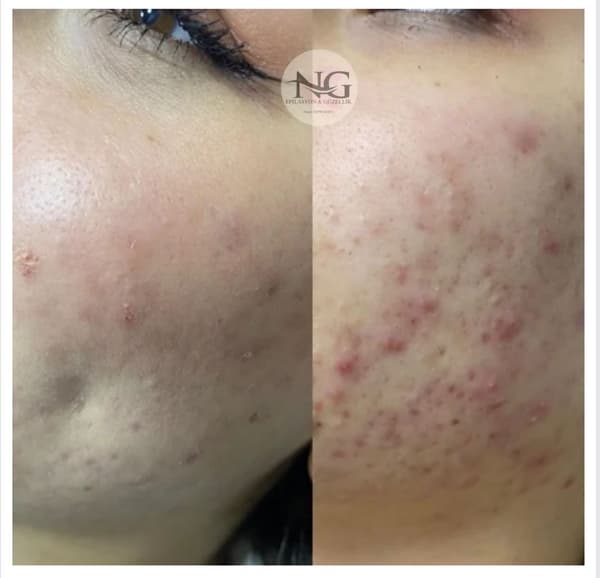 Nergis Epilasyon ve Güzellik - 12. Fotoğraf Nergis Epilasyon ve Güzellik - 12. Fotoğraf