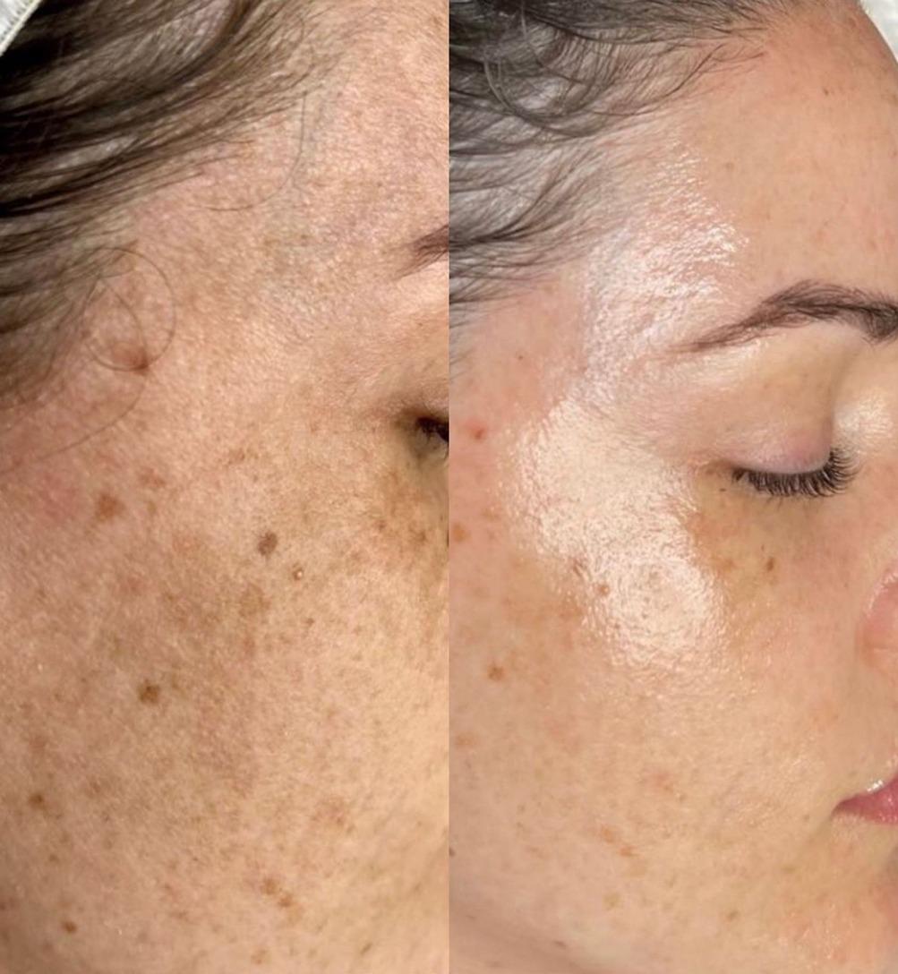 Rukiye Kuba Güzellik Salonu  - Kızılay  Gözenek Sıkılaştırma - 3. Fotoğraf